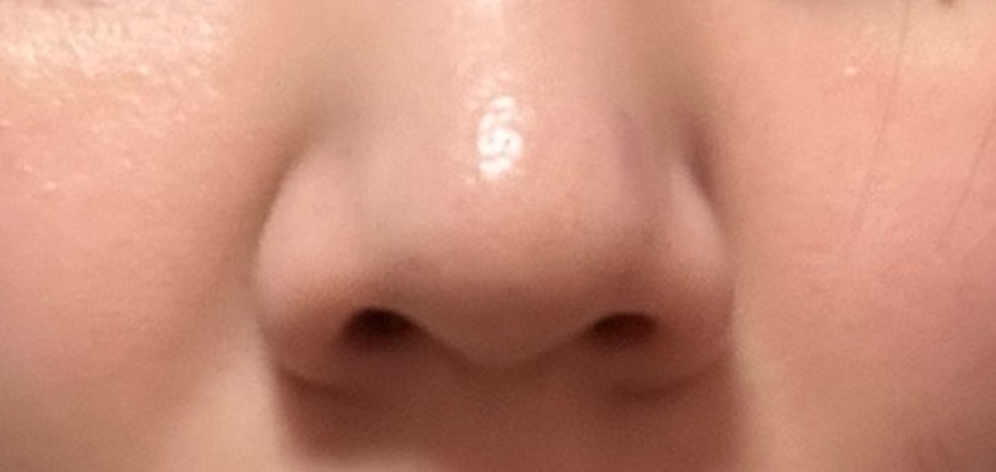 after photo: 脂肪溶解注射(顔)