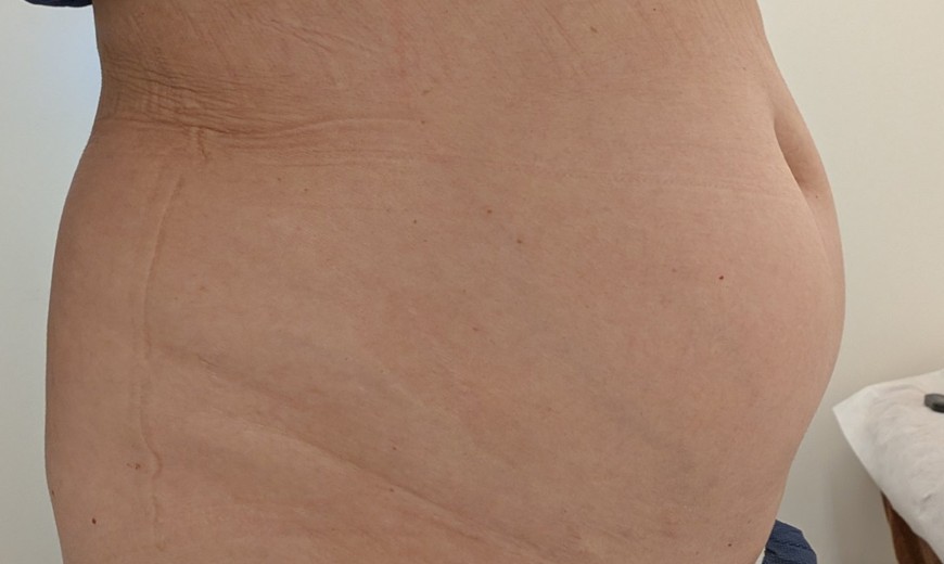 before photo: 脂肪冷却(腕), 脂肪冷却(腹部)
