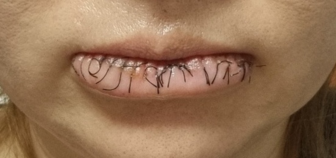 after photo: 입술축소술