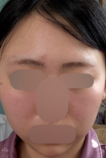 before photo: 脂肪溶解注射(顔)