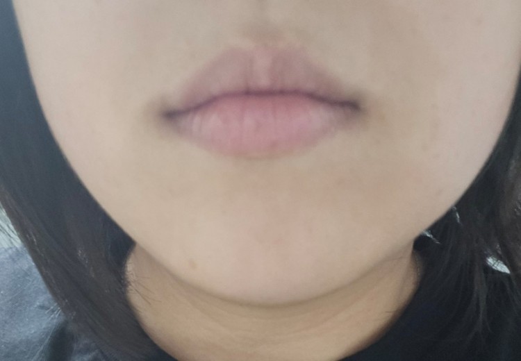 after photo: 사각턱보톡스, 튠라이너