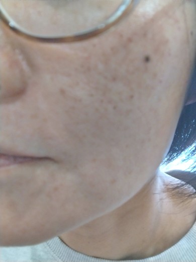 after photo: ピコトーニング