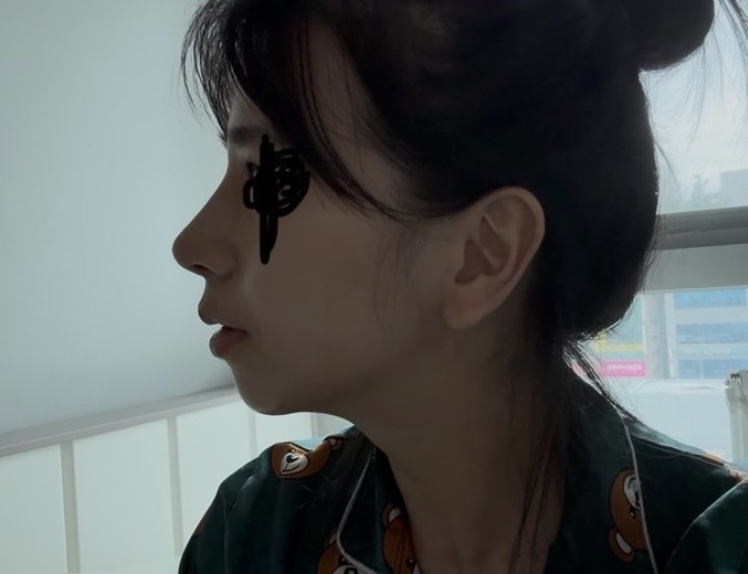 after photo: 비중격만곡증수술