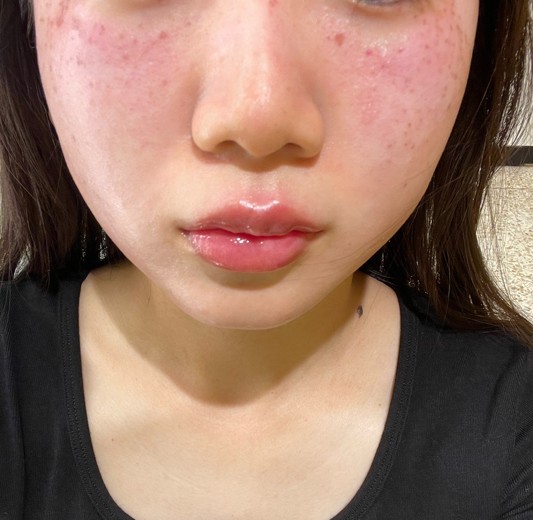after photo: PDTレーザー, フラクショナルレーザー, レーザートーニング, ほくろ除去(レーザー)