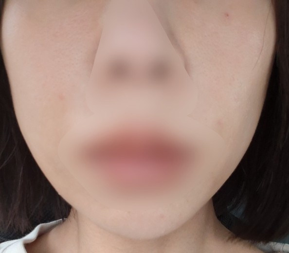 after photo: 糸リフト, メーラー/ジョール/バッカルファット除去