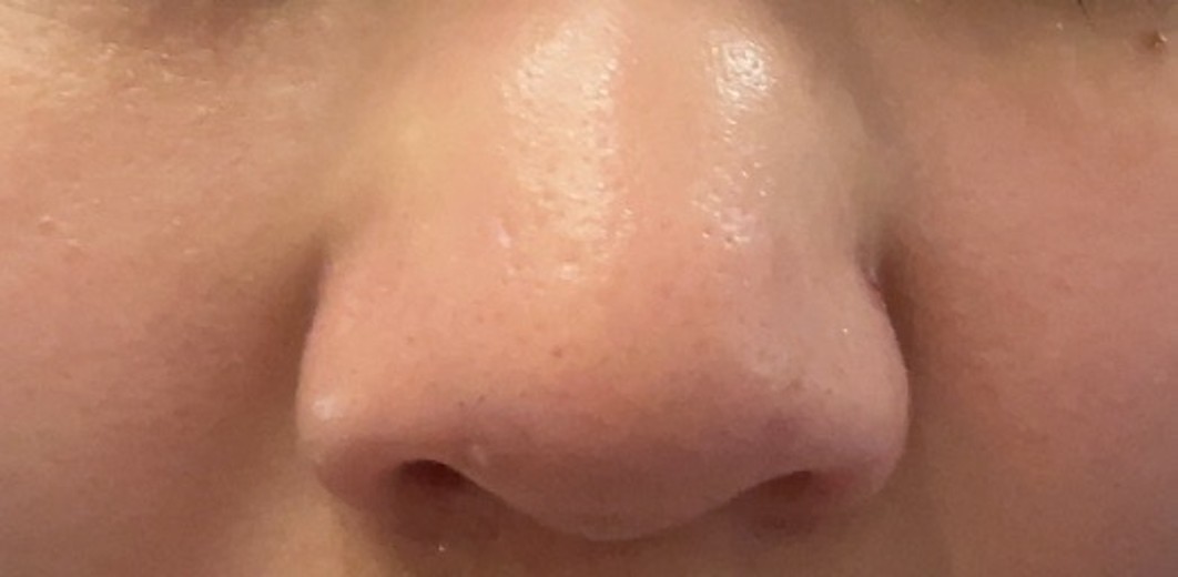 after photo: 脂肪溶解注射(顔)