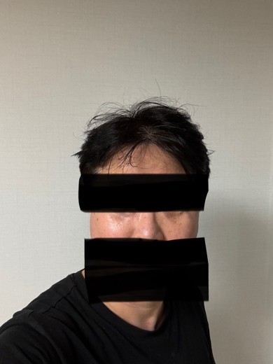 after photo: 눈밑지방재배치