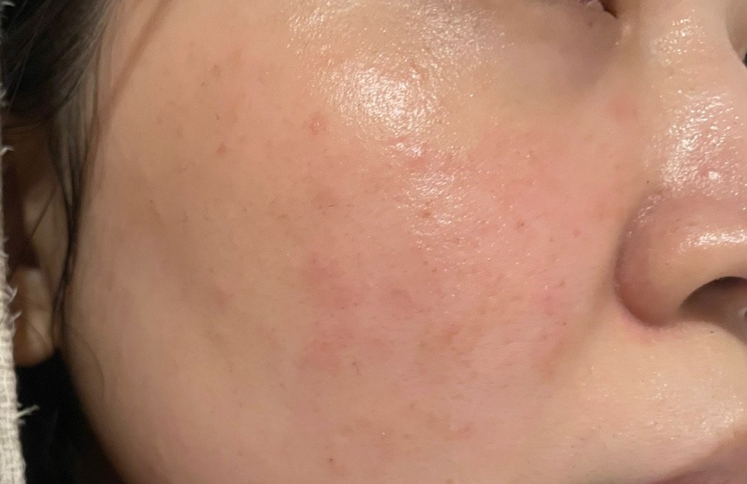 コラーゲンピールの施術・口コミ・クリニック情報(2026) | カンナムオンニ