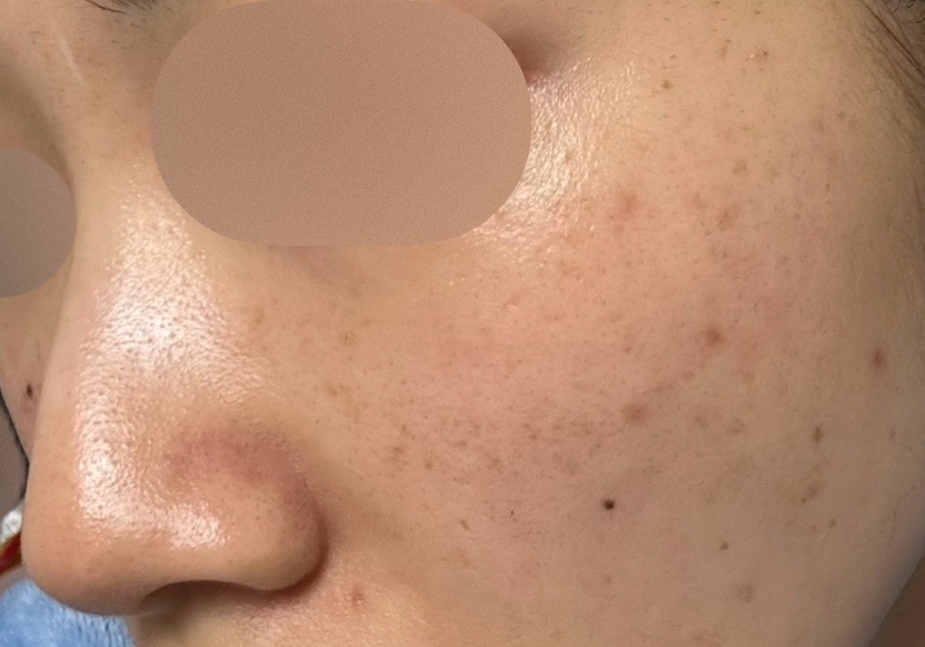 ピーリング　エレクトロポレーション 初診限定】ララピール（全顔）＋エレクトロポレーション