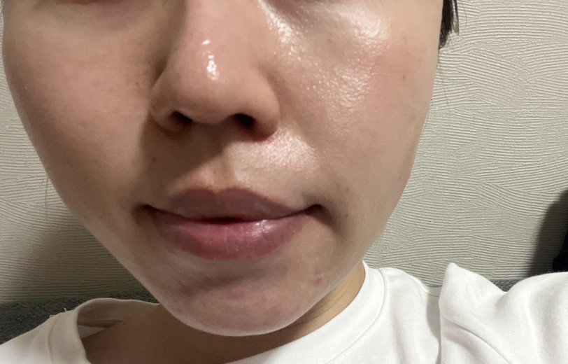 after photo: ピーリング, ルメッカ