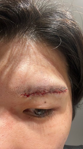 after photo: 眼瞼下垂(目つき矯正)