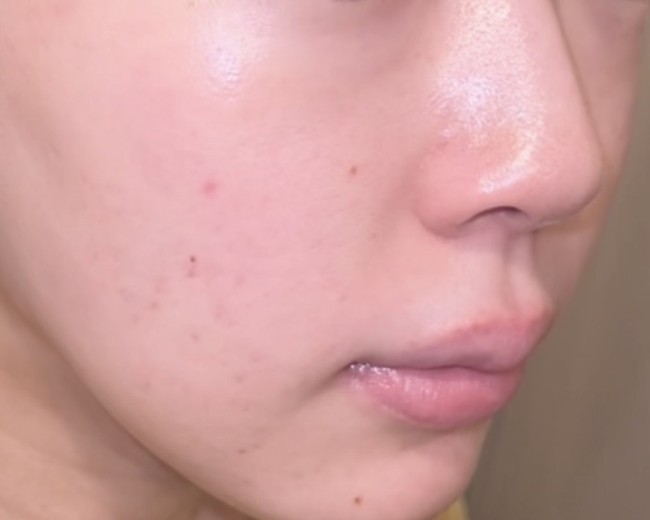 before photo: IPL(光/フォト治療), エレクトロポレーション, ルメッカ