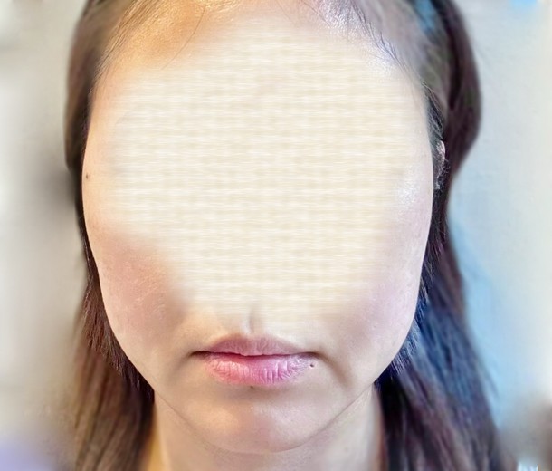 before photo: ボルニューマ