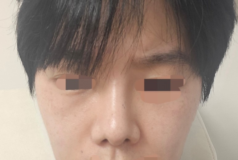 after photo: 비중격만곡증수술