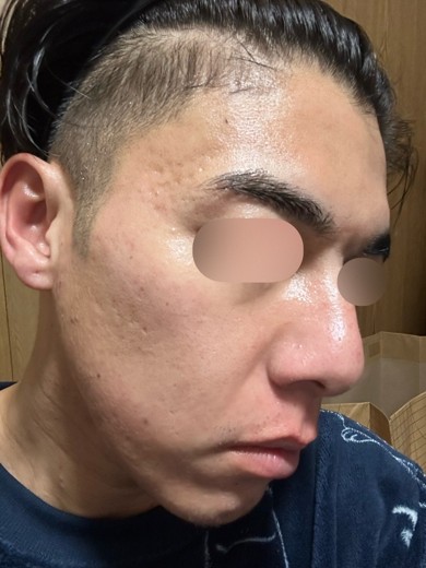 after photo: ダーマペン, エクソソーム
