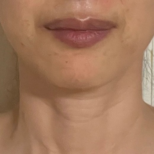 after photo: 입술축소술