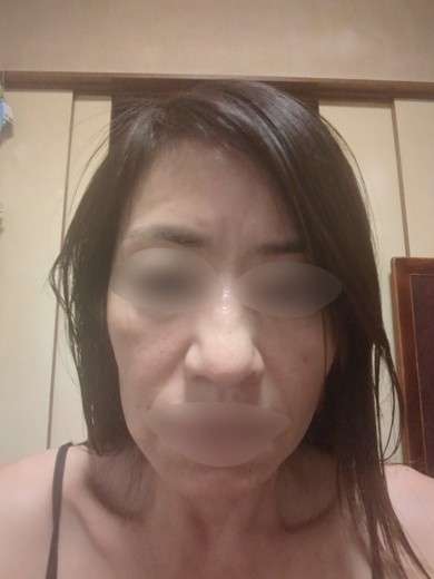 after photo: ハイドラフェイシャル, 診断・検査