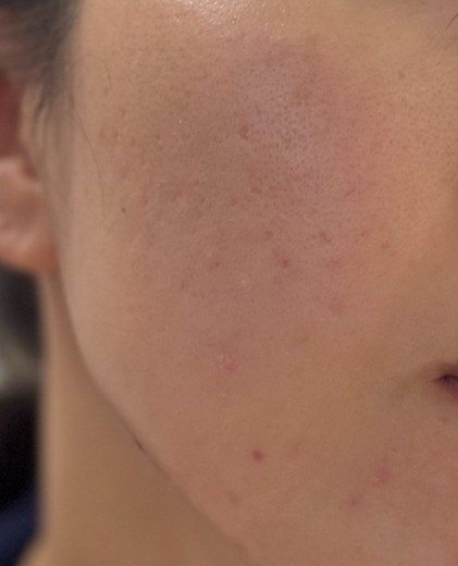 before photo: ダーマペン