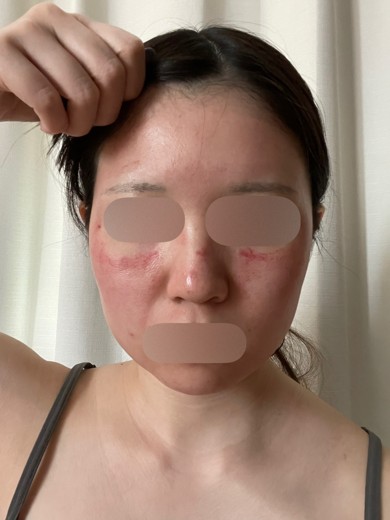 after photo: ダーマペン, エクソソーム