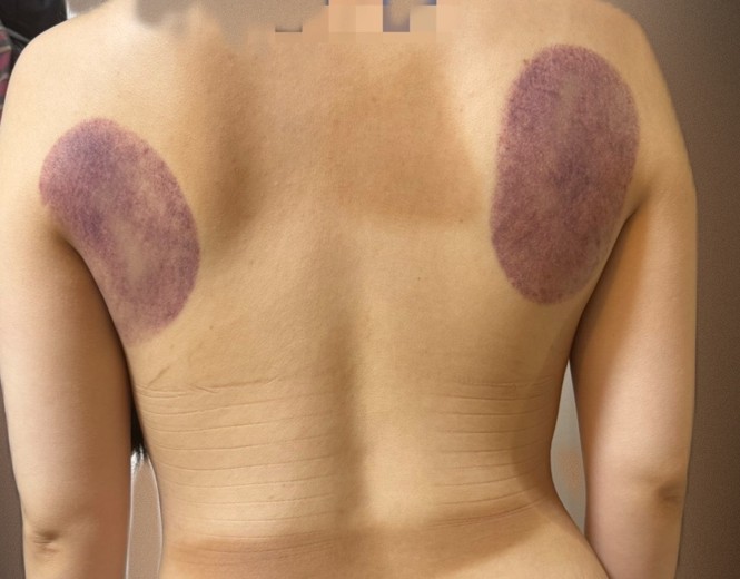 after photo: 脂肪冷却(背中)