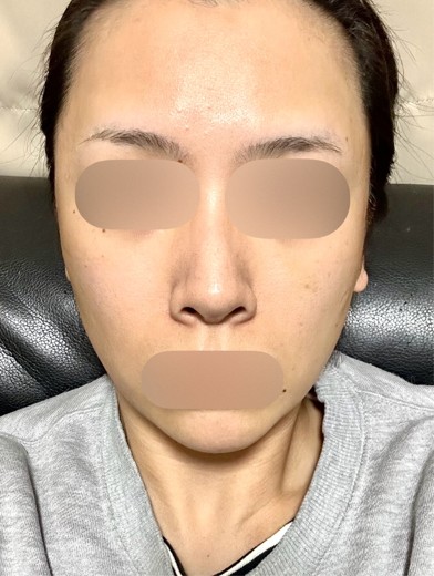 after photo: ジュベルック(Juvelook)
