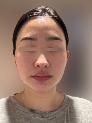 before photo: エレクトロポレーション