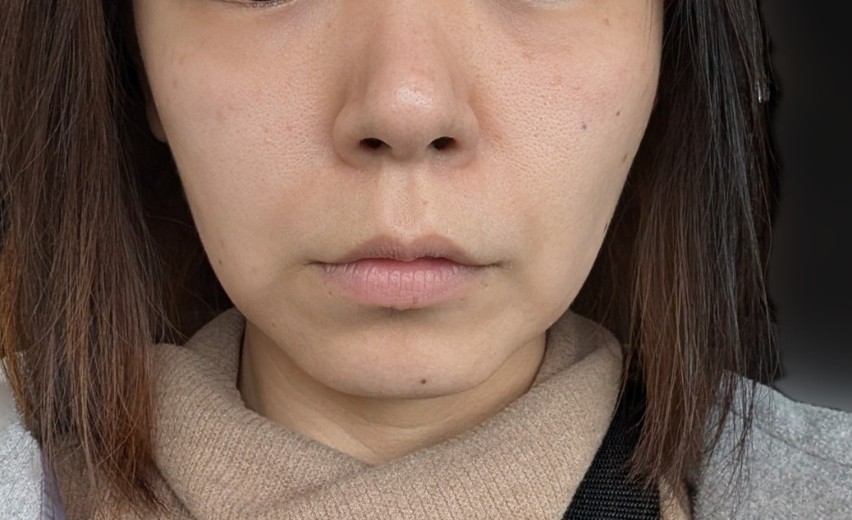 after photo: ハイフ(HIFU)