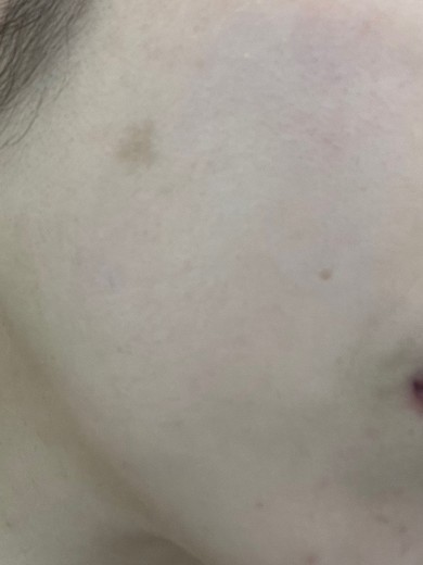 before photo: エレクトロポレーション, 診断・検査