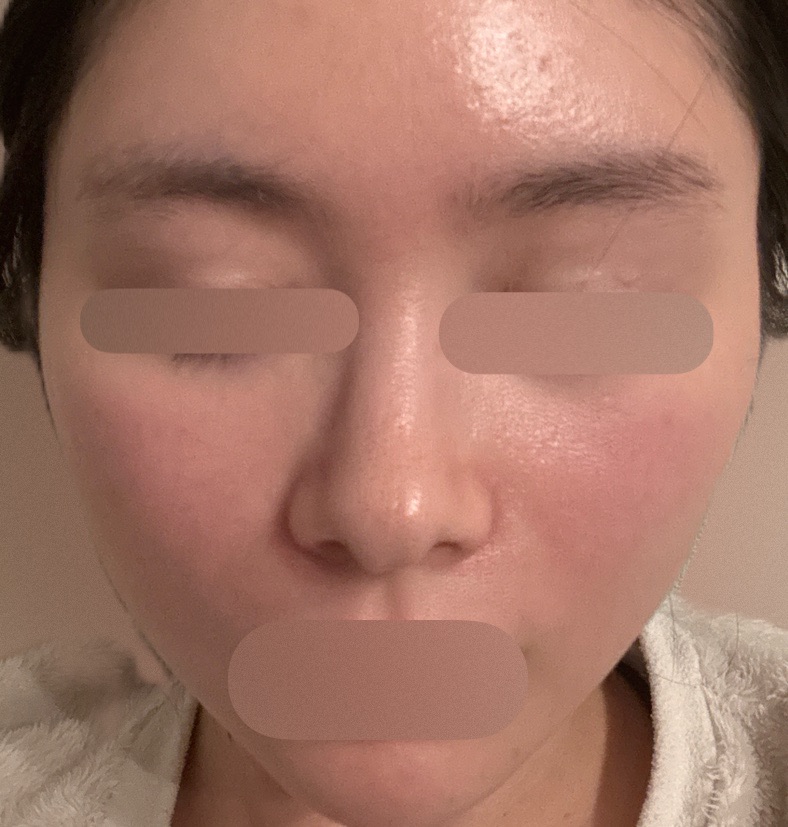 エレクトロポレーション【再来OK】 | ライズワン美容皮膚科クリニック