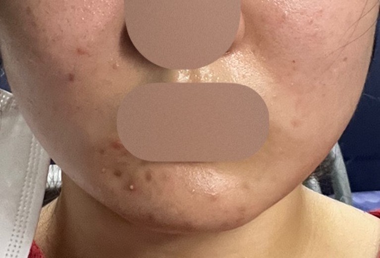 before photo: 여드름압출