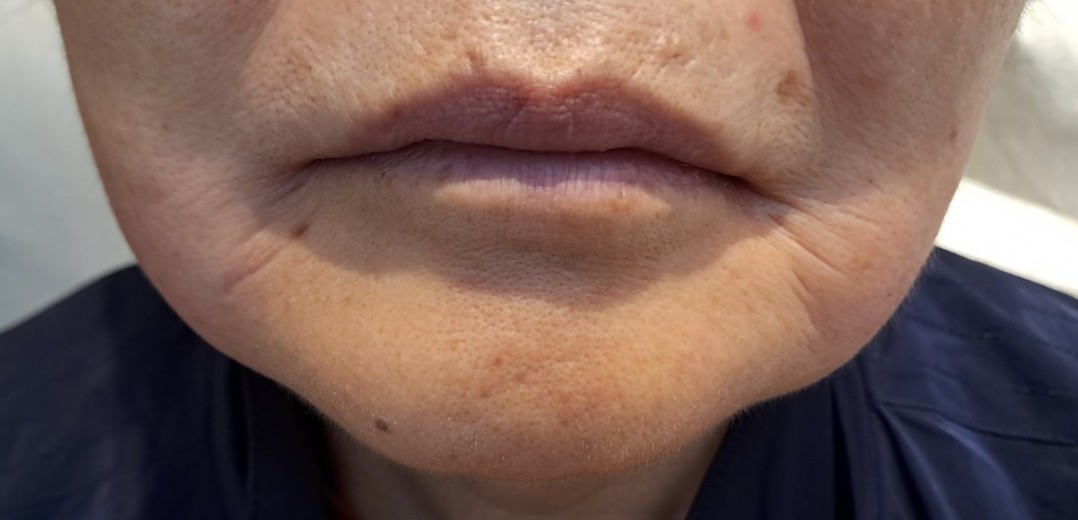 after photo: 윤곽주사, 얼굴지방분해주사