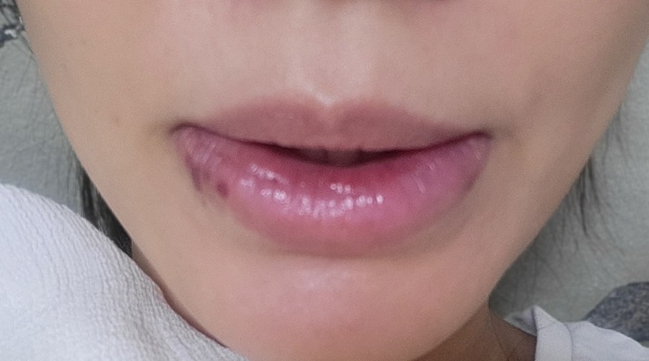 after photo: 입술축소술