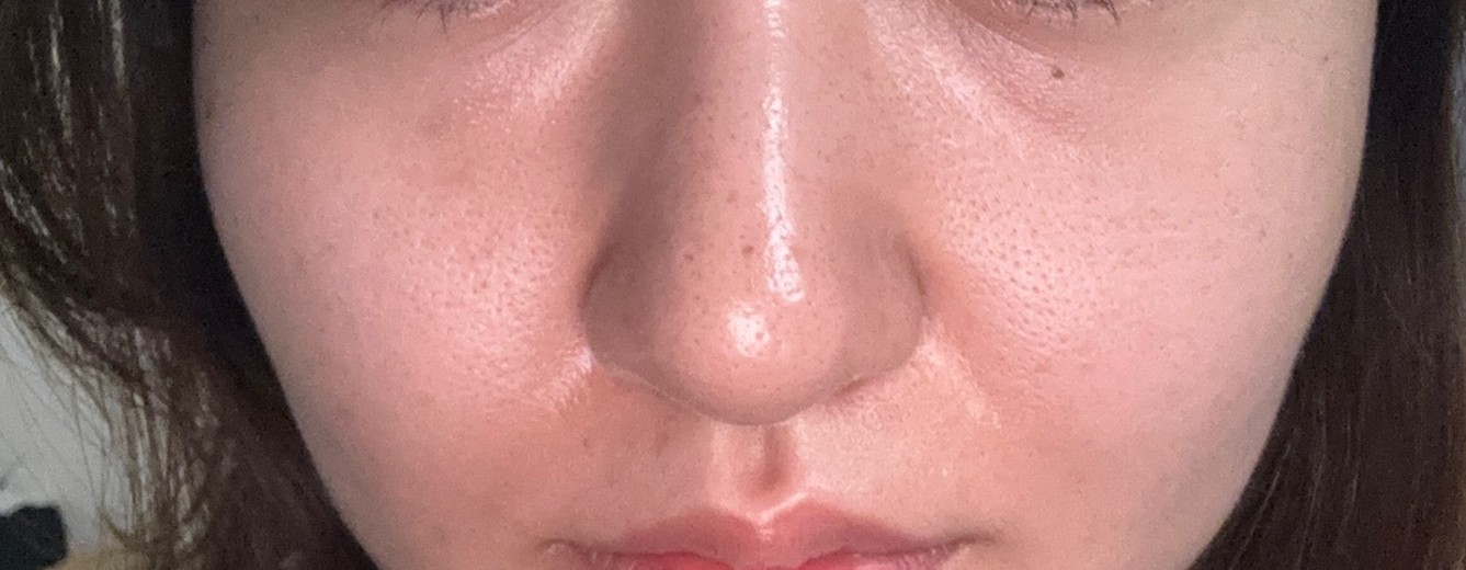 after photo: 小鼻ボトックス, 脂肪溶解注射(顔)