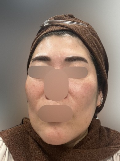 after photo: ヴェルベットスキン