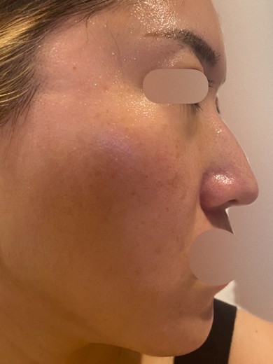 after photo: フラクショナルレーザー, ピコトーニング, 診断・検査