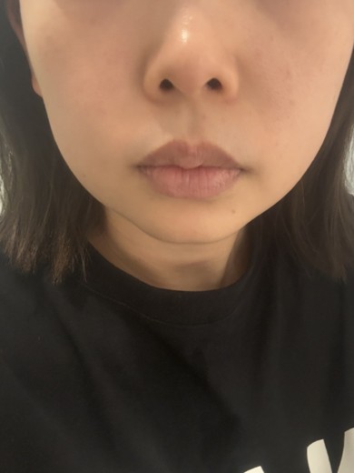 before photo: あごヒアルロン酸, 頬ヒアルロン酸
