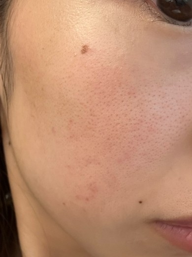 after photo: IPL(光/フォト治療), ルメッカ