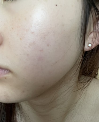 after photo: IPL(光/フォト治療), 診断・検査