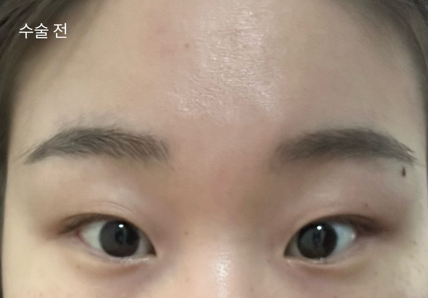 시술 전
