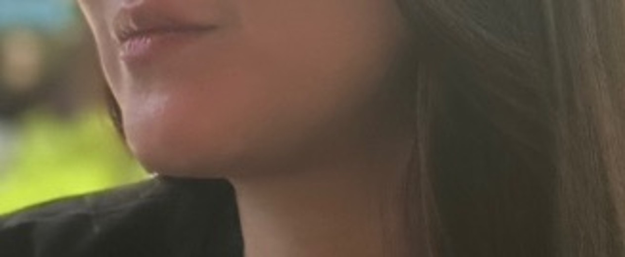 before photo: 인모드리프팅