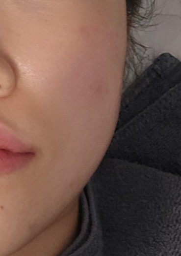 before photo: 포트라리프팅