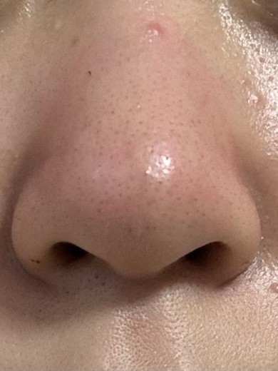 after photo: 小鼻ボトックス, 脂肪溶解注射(顔)