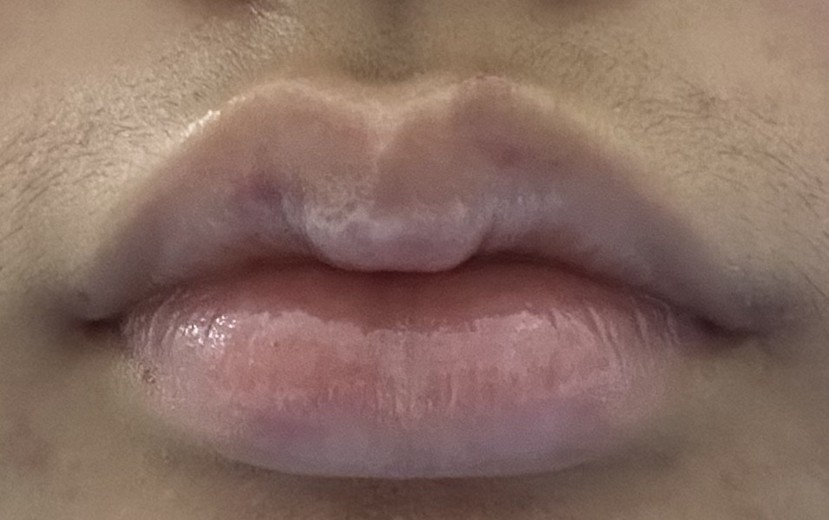 after photo: 입꼬리필러, 입술필러