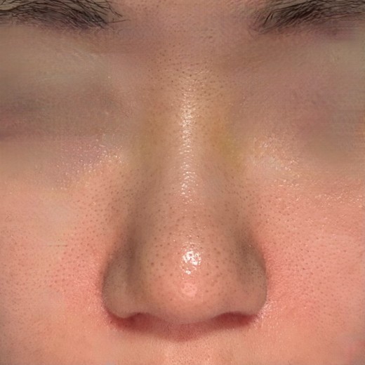 after photo: 콧볼축소, 복코교정(수술)