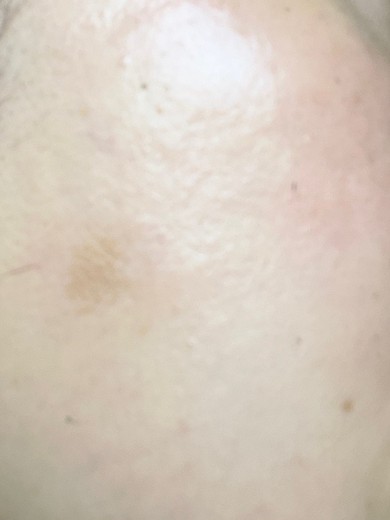 after photo: エレクトロポレーション, 診断・検査