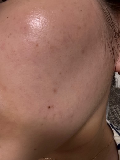 after photo: IPL(光/フォト治療), ハイドラジェントル