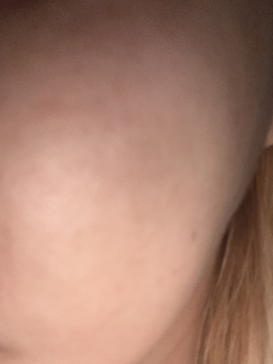 after photo: 리쥬란힐러, 스킨보톡스