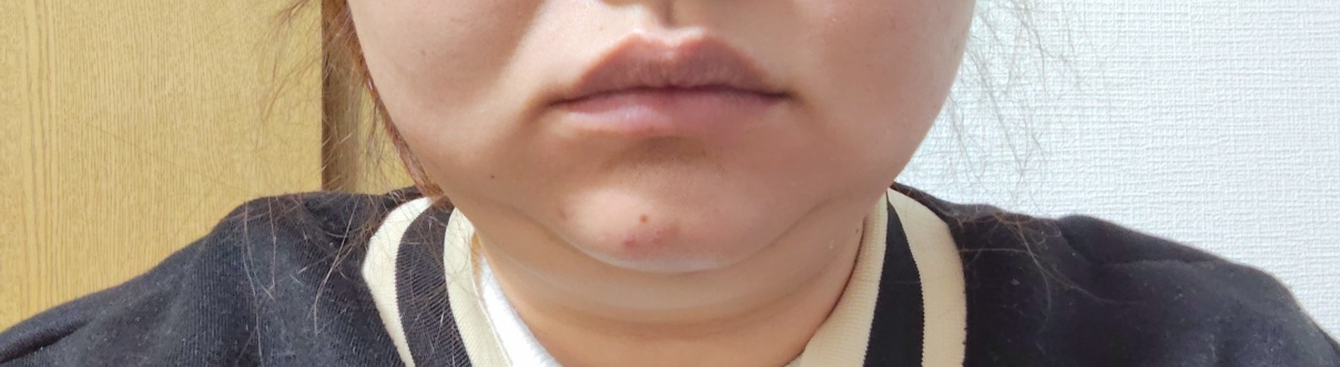 before photo: 脂肪溶解注射(顔)