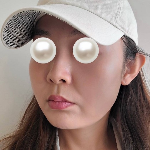 before photo: 울쎄라피프라임