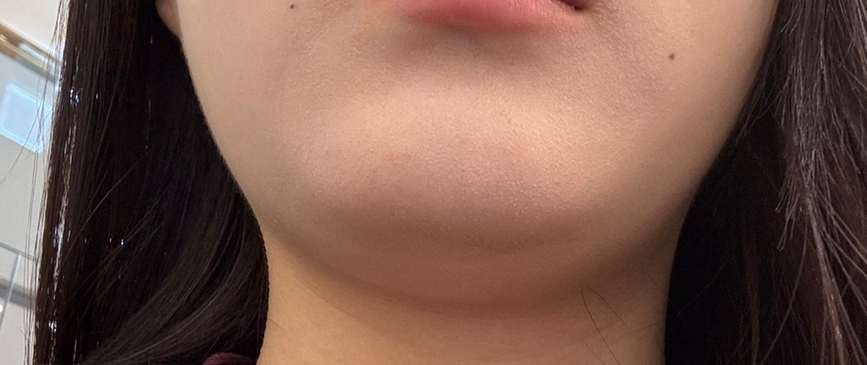 before photo: 슈링크유니버스